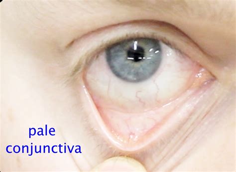 Conjunctival-pallor1_Fotor_Fotor - Child Health