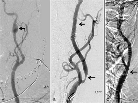 Complications of Carotid Endarterectomy | Neupsy Key