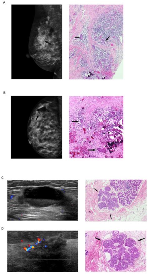 Mammogram and ultrasound findings post biopsy but before subsequent... | Download Scientific Diagram