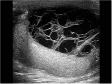 Urinary Tract and male reproductive system | 2.3 Scrotum : Case 2.3.2 ...