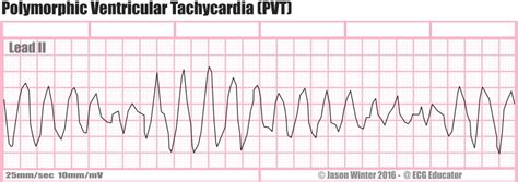 What is Ventricular Tachycardia (V-Tach)? - Boss RN