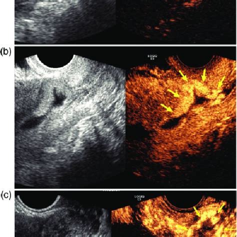 Myometrial thickness as measured by transvaginal ultrasound (a) and ...