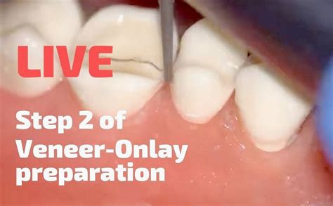 TOOTH PREPARATION: Veneer-Onlay preparation