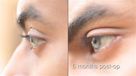 Eye color change surgery 6 months post op brightocular - YouTube