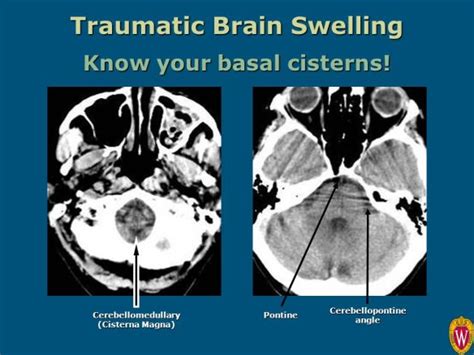 Basal Cisterns Anatomy