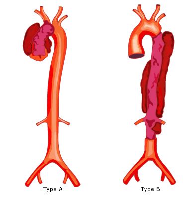 Aortic Dissection - RCEMLearning