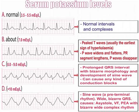 Sine Wave Hyperkalemia Ecg Changes