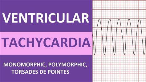 Polymorphic Ventricular Tachycardia Ecg