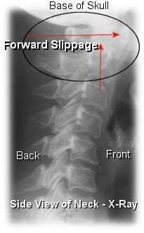 Rheumatoid Arthritis Neck