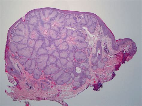 Sebaceous Adenoma - The Clinical Advisor