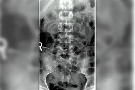 About tailbone injury | General center | SteadyHealth.com