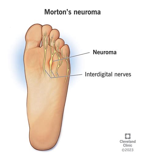 Morton’s Neuroma: Causes, Symptoms & Treatment