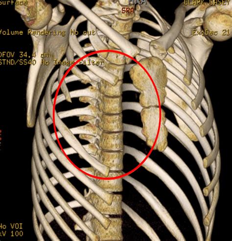 Chest wall lumps | Rib Injury Clinic