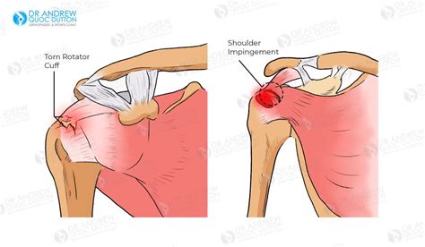 Rotator Cuff Tears and Shoulder Impingement Injuries | Dr. Dutton