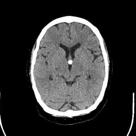 Brain Third Ventricle Mri