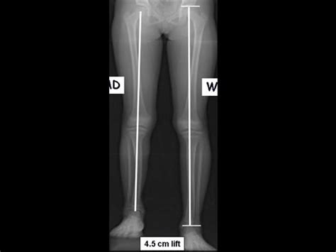 Leg Length Discrepancy (LLD) - Pediatrics - Orthobullets