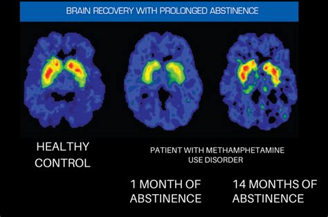 The Brain in Recovery - Recovery Research Institute