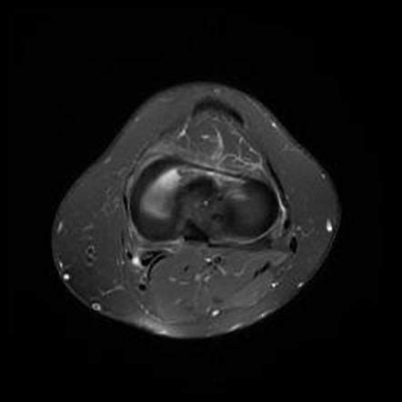 Transverse Ligament Of The Knee