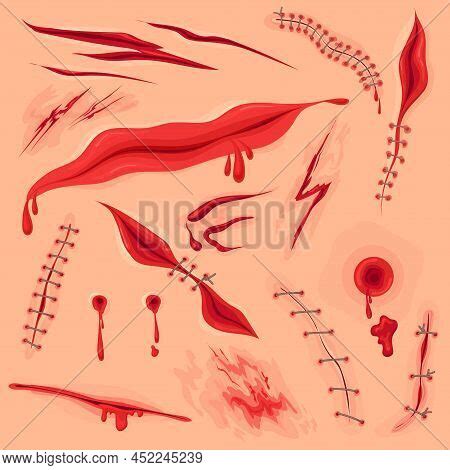 Skin Incision Wound. Vector & Photo (Free Trial) | Bigstock