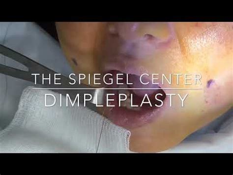 DIMPLEPLASTY - YouTube