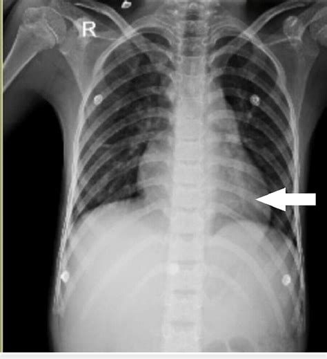 Chest X-ray of the patient revealed cardiomegaly | Download Scientific ...