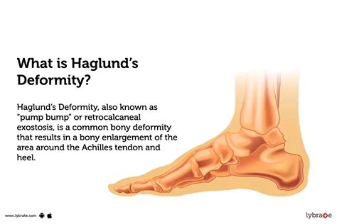 Haglund's Deformity: Causes, Symptoms, Treatment and Cost