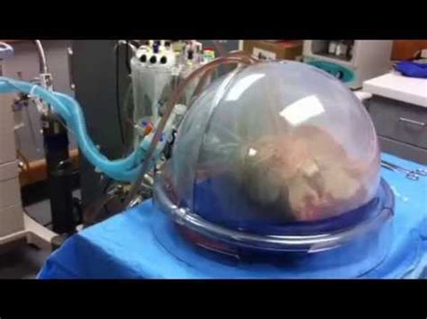 Ex-Vivo Lung Perfusion (EVLP) - YouTube