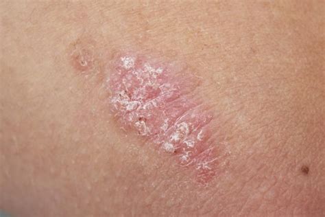 Could You Have Lupus That Only Affects the Skin? em 2020 | Sistema imunológico, Pele, Obesidade