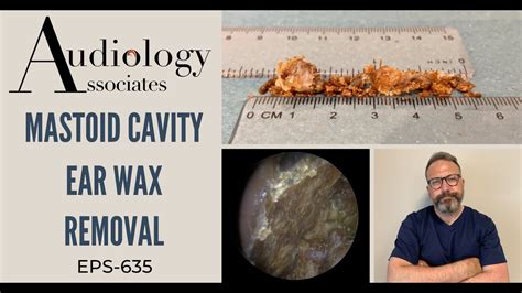 MASTOID CAVITY EAR WAX REMOVAL - EP635 - YouTube