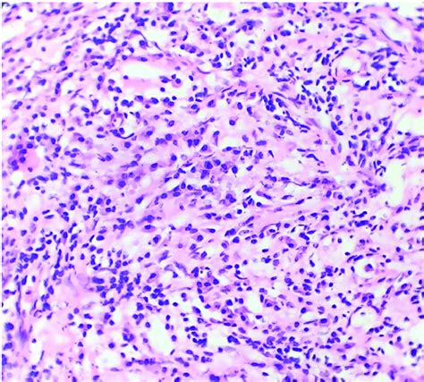 Histopathological examination with dense aggregates of inflammatory... | Download Scientific Diagram