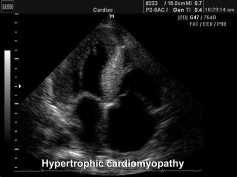 MEDISON.RU - Hypertrophic cardiomyopathy (№185, SA-9900)