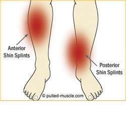 Shin Splints Diagram - Muscle Pull | Muscle Pull