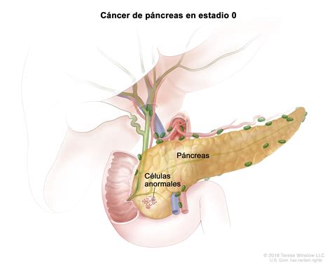 Tratamiento del cáncer de páncreas - NCI