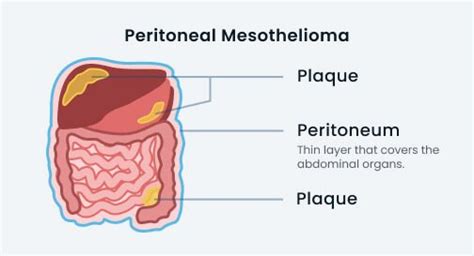 Peritoneal Mesothelioma: Causes, Symptoms and Treatment Options