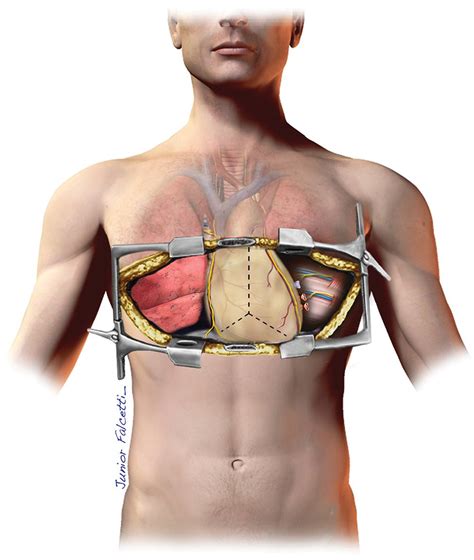 SciELO - Brasil - A simple technique can reduce cardiopulmonary bypass use during lung ...