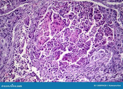 Squamous cell carcinoma in lung