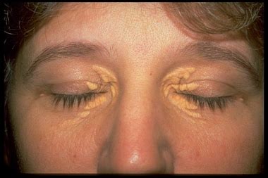 Xanthelasma: Background, Pathophysiology, Epidemiology