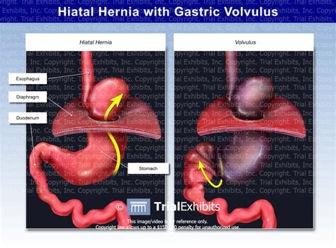 Hiatal Hernia with Gastric Volvulus - Trial Exhibits Inc.