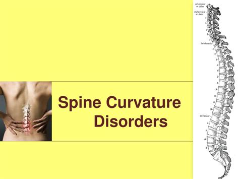 PPT - Spine Curvature Disorders PowerPoint Presentation, free download ...