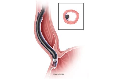 Evaluating the role of peroral endoscopic myotomy in the treatment of achalasia - Mayo Clinic