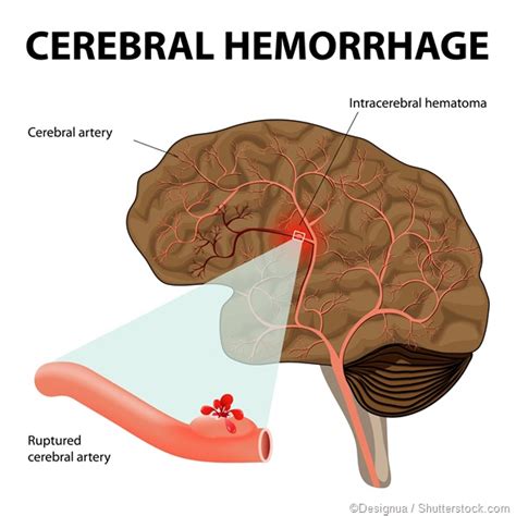 Subarachnoid Hemorrhage Vs Intracerebral Hemorrhage