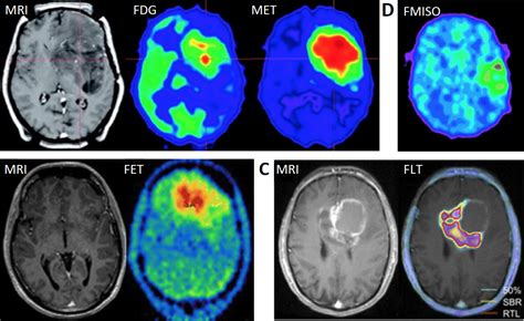 Mri Scan Brain Tumor