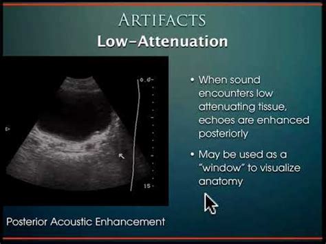 Bladder Ultrasound/KUB - YouTube