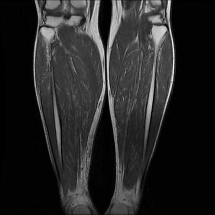 Plantaris Muscle Mri