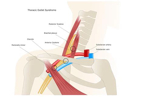 Thoracic outlet - Central Lakes Physio & Pilates