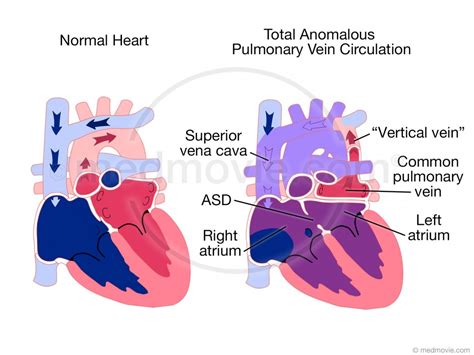 Medmovie.com | Total Anomalous Pulmonary Vein Circulation (TAPVC)