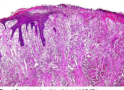 Epulis Fissuratum Histology