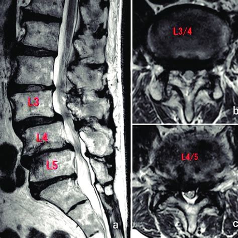 Foraminal Stenosis Mri