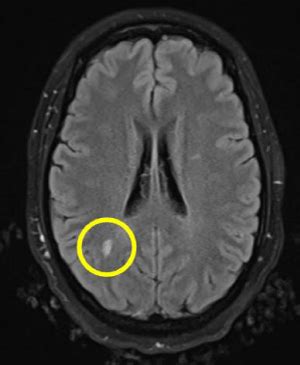 Atypical Presentation of Multiple Sclerosis Presents Diagnostic Challenges