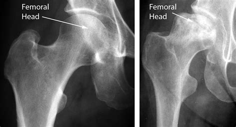 Hip Avascular Necrosis Osteonecrosis Avn Necrosis Of - vrogue.co